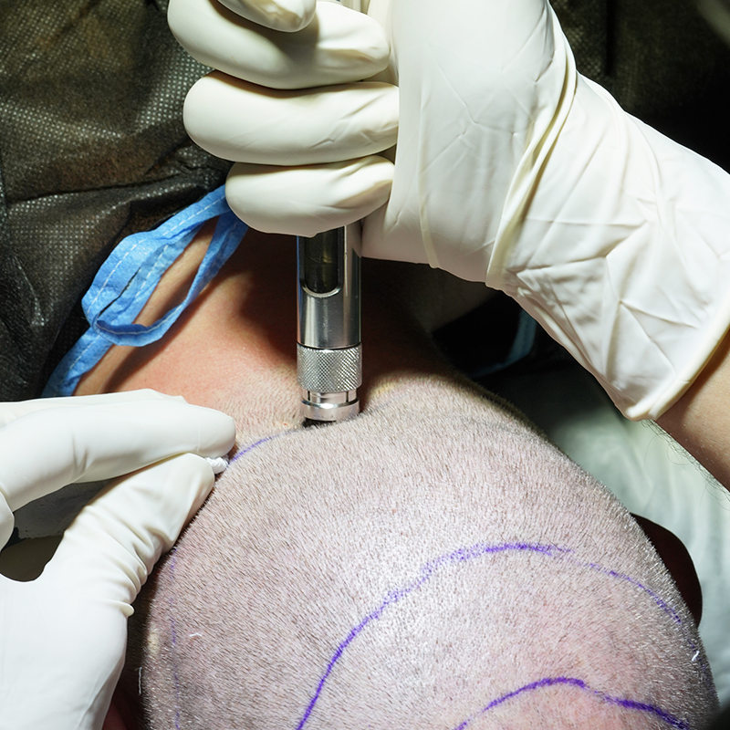 ما هي الاختلافات بين زراعة الشعر بتقنية السفيرSapphire FUE  و  FUE.