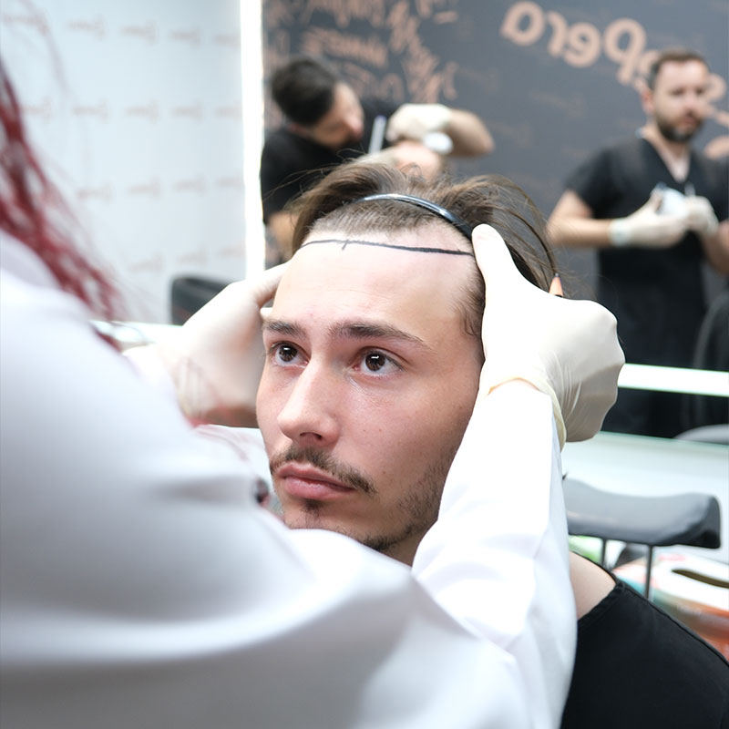التوقيت هو كل شيء: قص الشعر بعد عملية زراعة الشعر