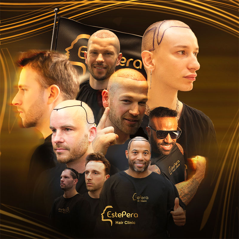 زراعة الشعر في المكسيك vs في تركيا