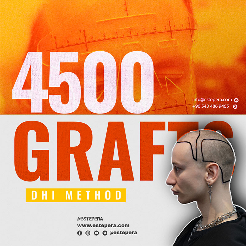 هل زراعة الشعر مؤلمة؟