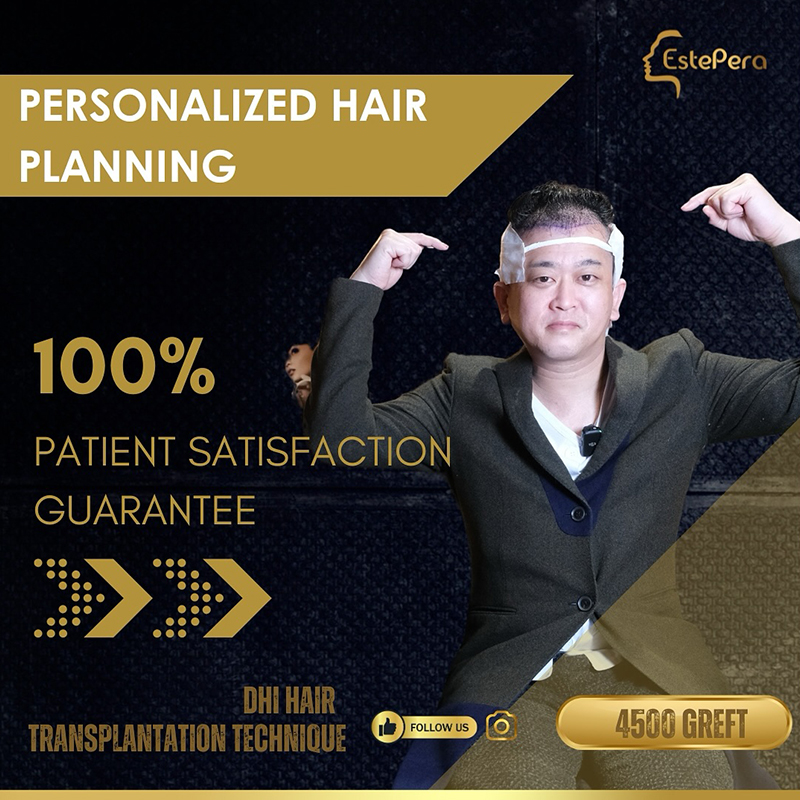 استعادة زراعة الشعر