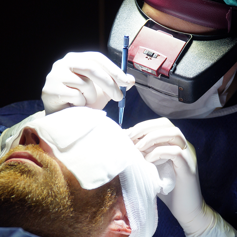 Transplantace vlasů safírového FUE