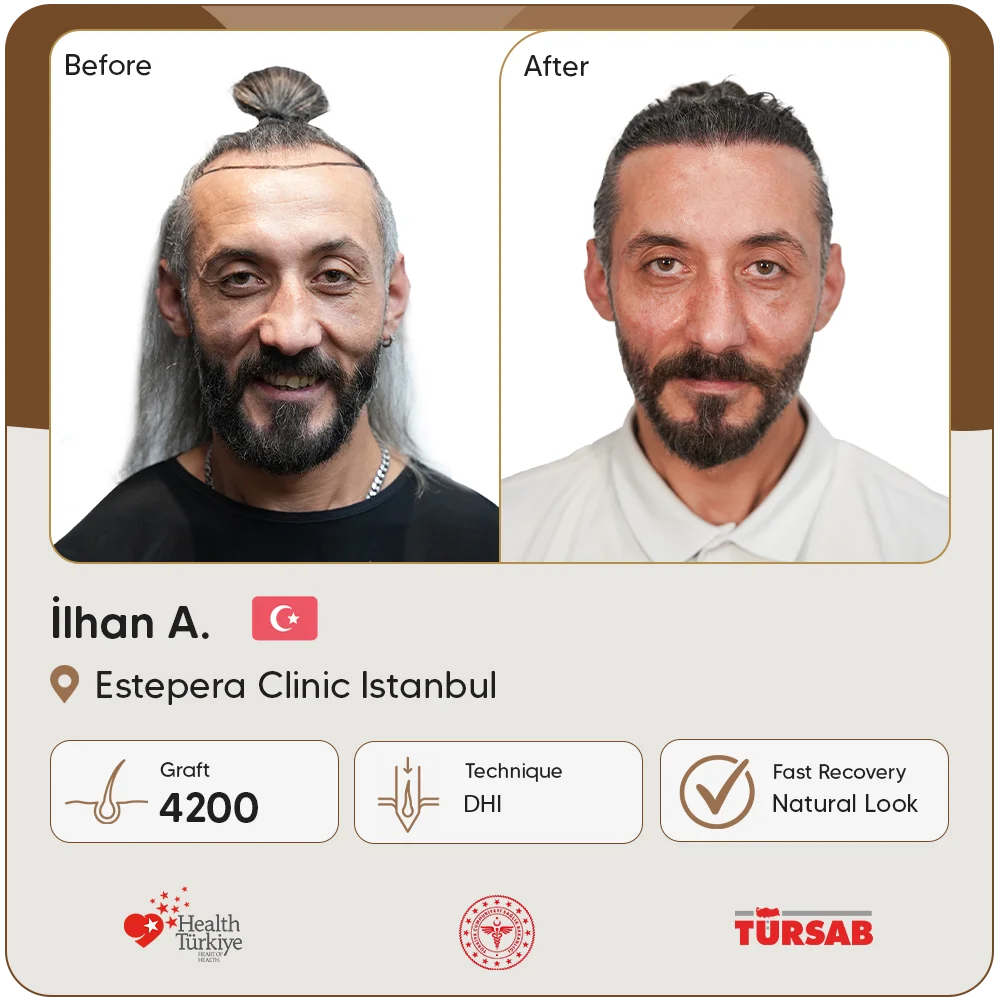 Haartransplantation Türkei