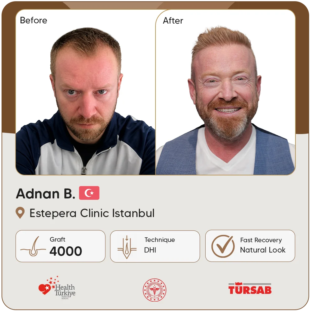 Haartransplantation Türkei