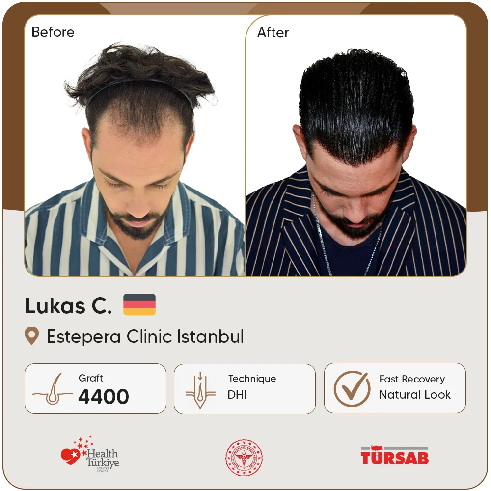 Haartransplantation Türkei