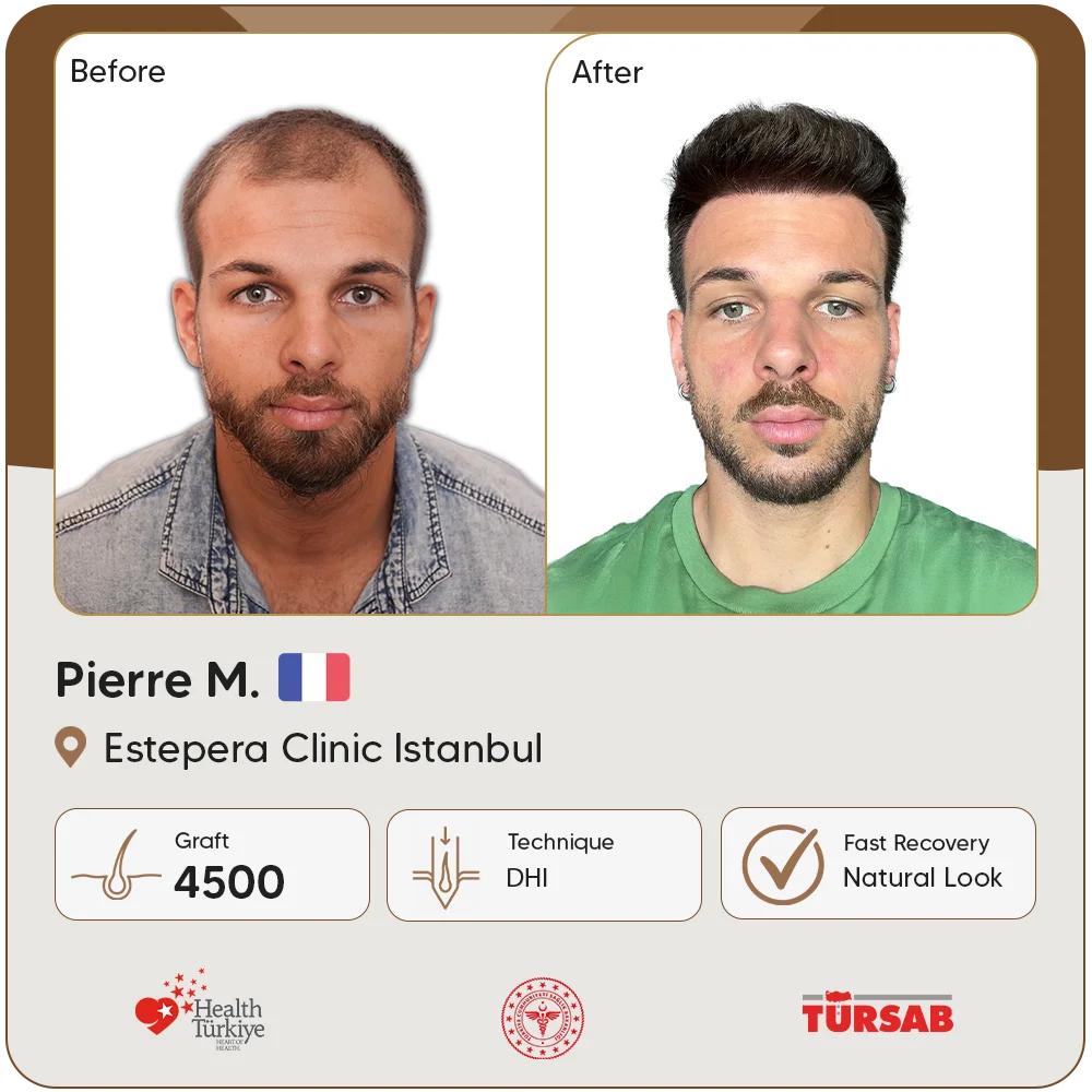 Haartransplantation Türkei