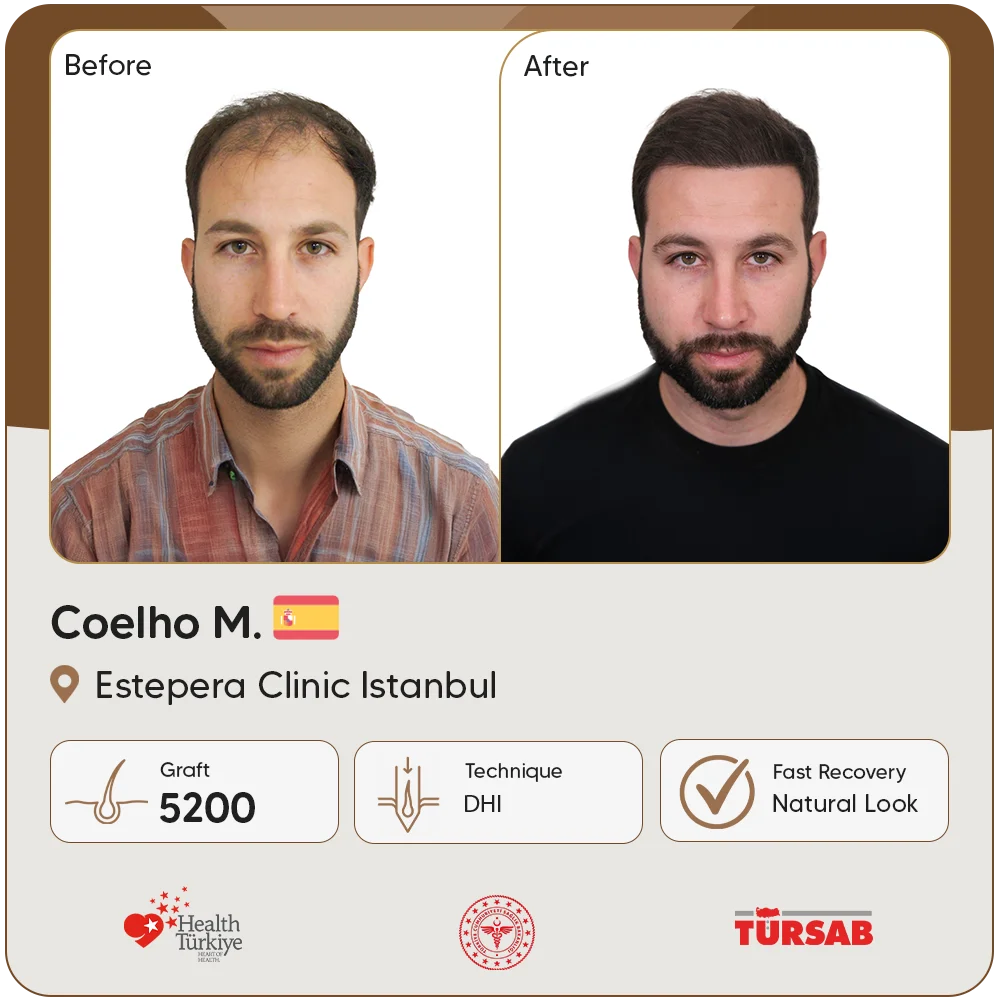 Haartransplantation Türkei