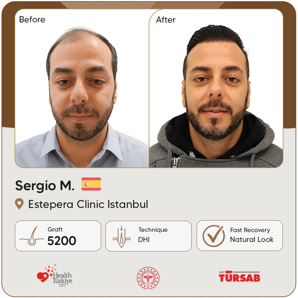 Haartransplantation Türkei