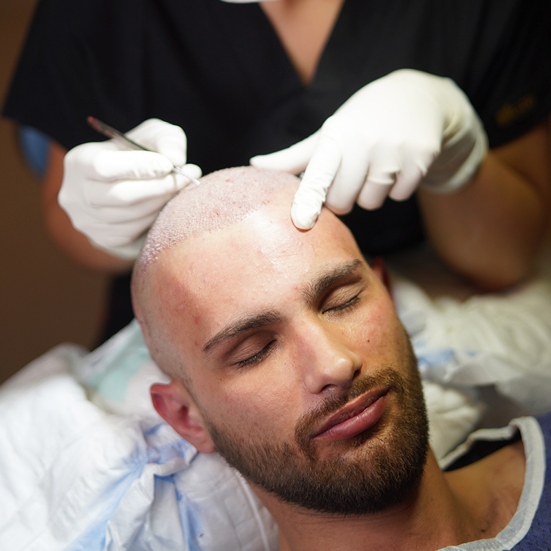 Greffe de cheveux chez les patients VIH