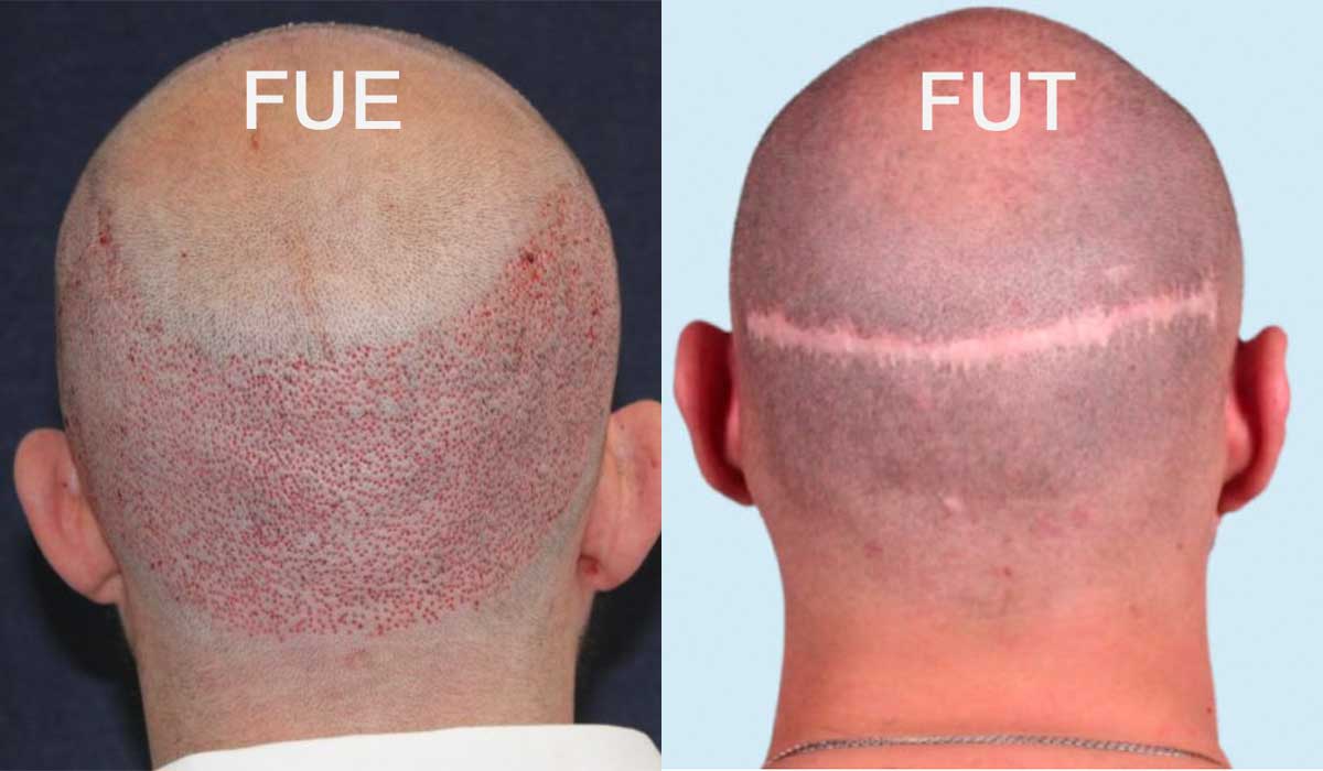 FUE VS FUT hair transplant