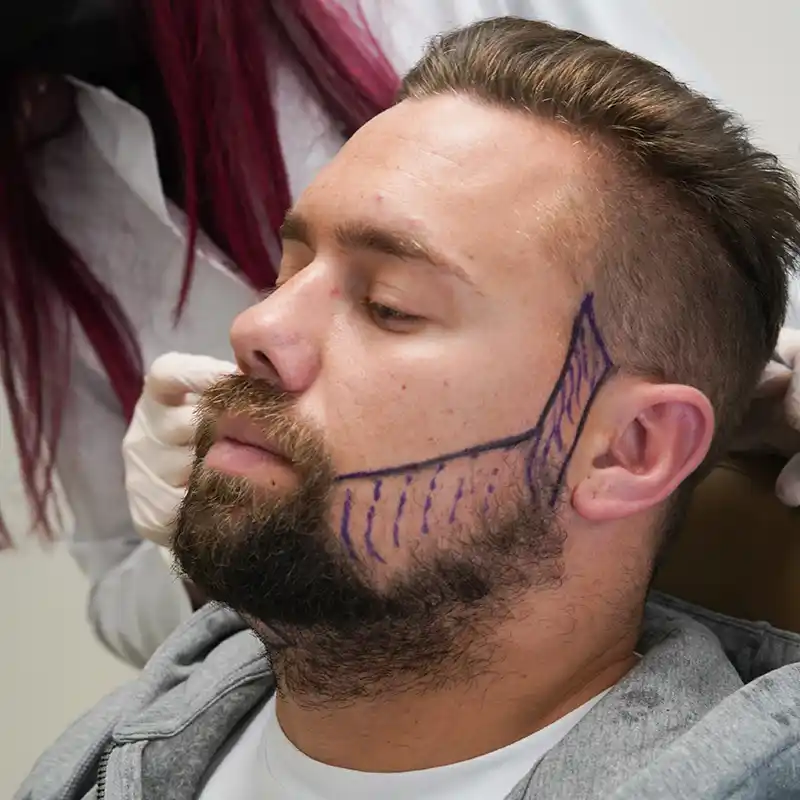 Greffe de Barbe Turquie