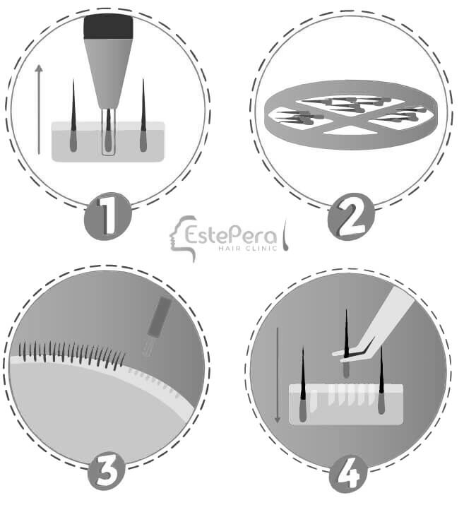 Hair Transplantation Estepera