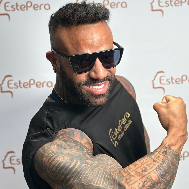 Quando Iniziano a Cadere i Capelli Trapiantati Dopo un Trapianto di Capelli?