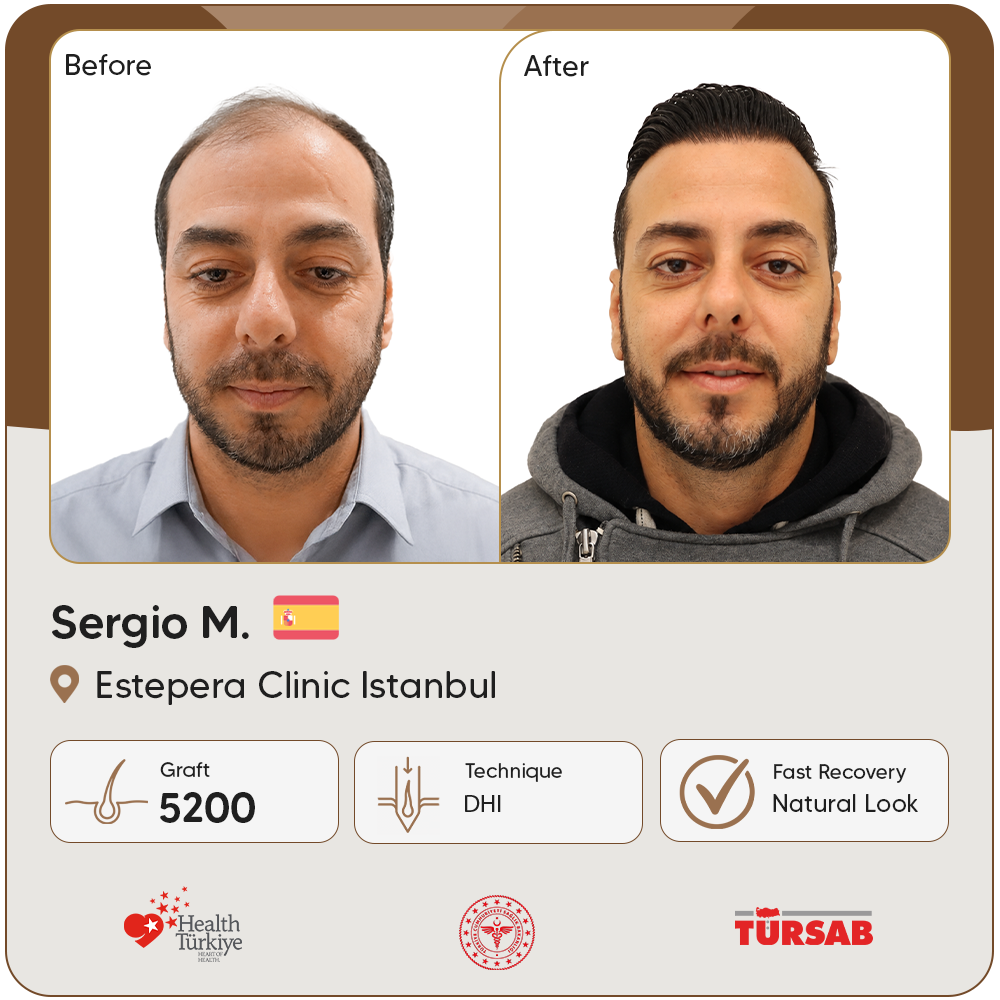 greffe de cheveux Turquie avant apres