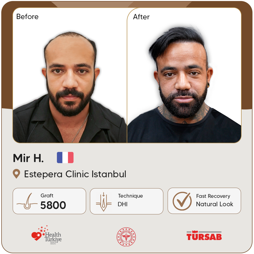 greffe de cheveux Turquie avant apres