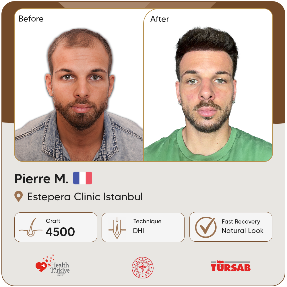 greffe de cheveux Turquie avant apres