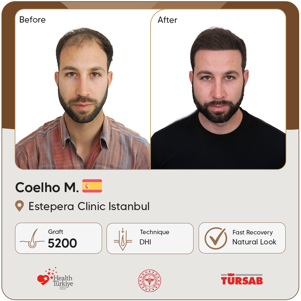 greffe de cheveux Turquie avant apres