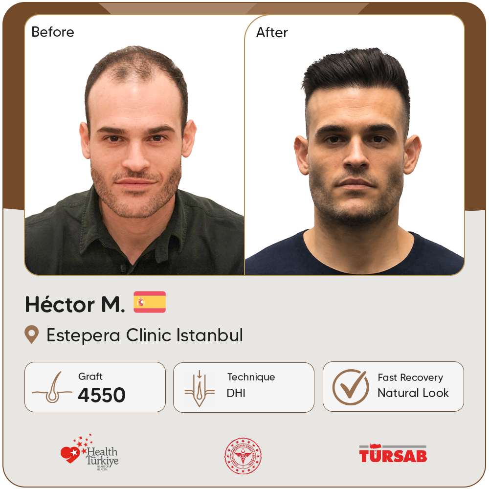 greffe de cheveux Turquie avant apres