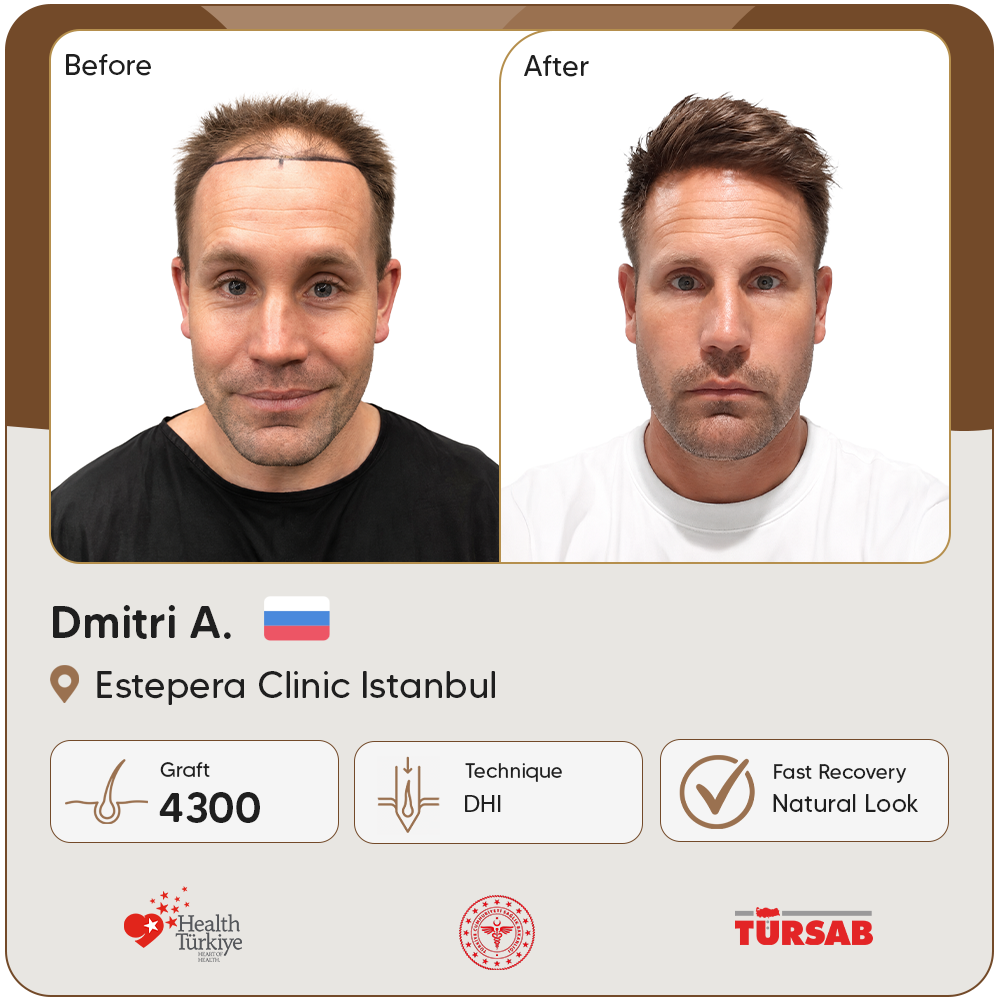 greffe de cheveux Turquie avant apres