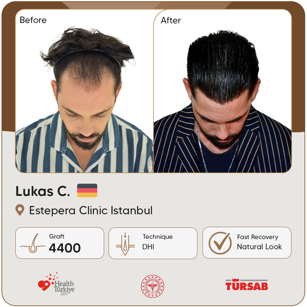 greffe de cheveux Turquie avant apres