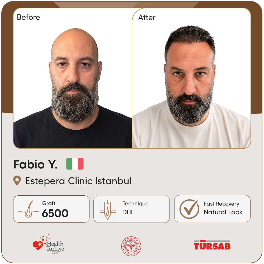 greffe de cheveux Turquie avant apres
