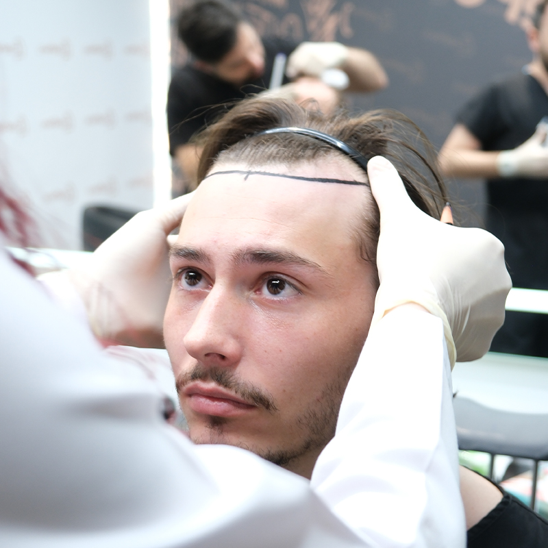 Operacja Obniżenia Linii Włosów W Turcji