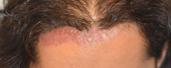 Nawracający Strup na Skórze Głowy Tym Samym Miejscu 1 Seborrheic Dermatitis
