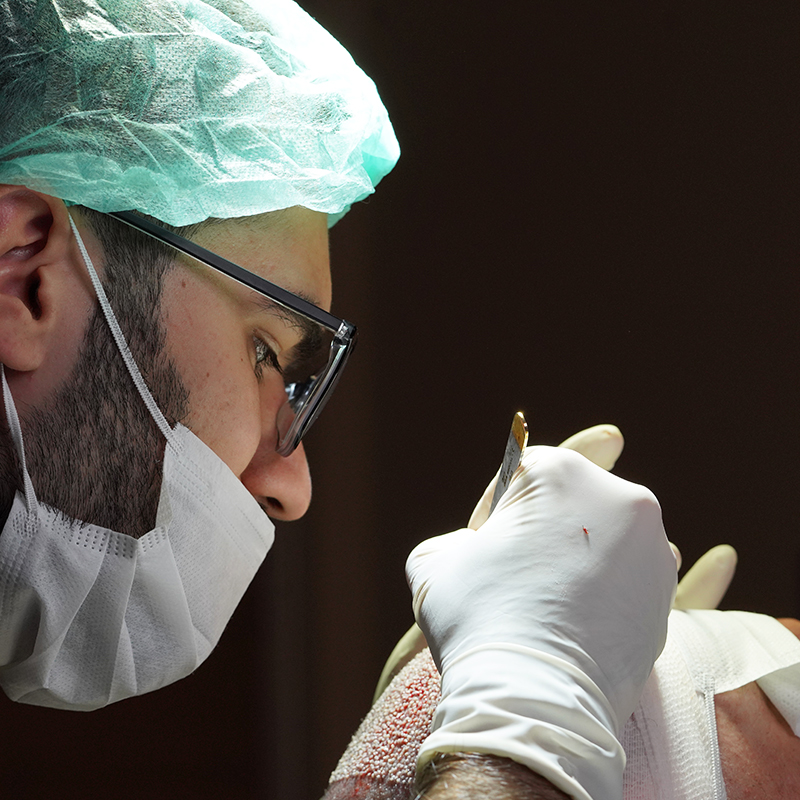 Razões Da Perda De Cabelo Em Homens e Soluções Permanentes