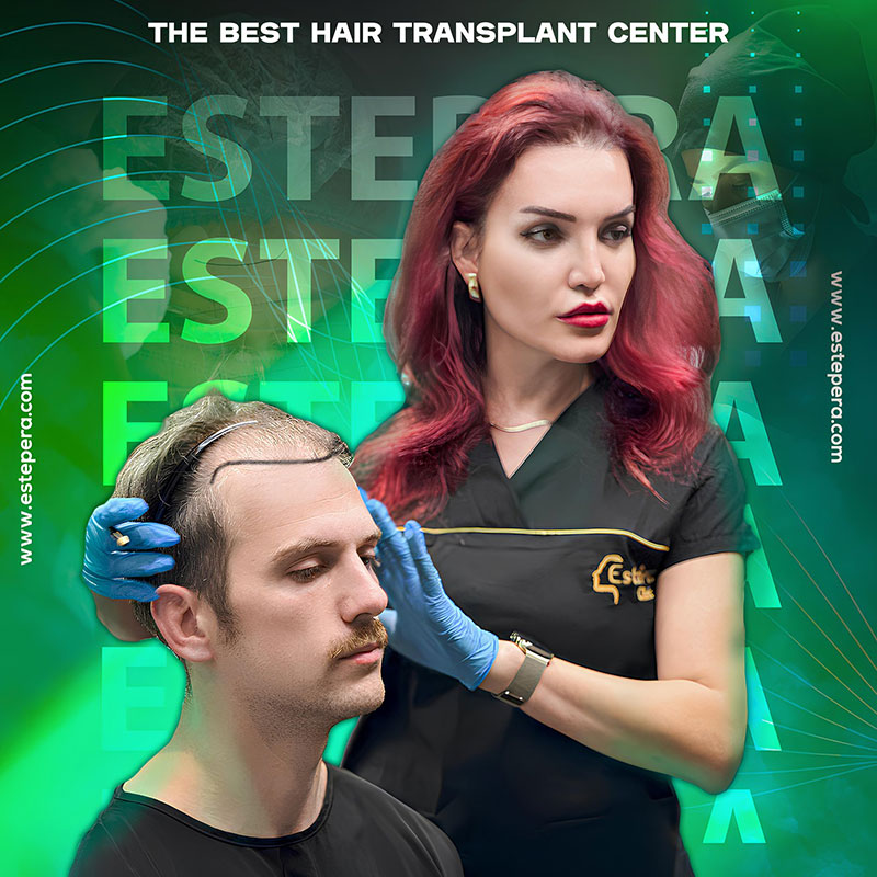 Môžem dostať transplantáciu vlasov s 5000 štepiami v jednej relácii?