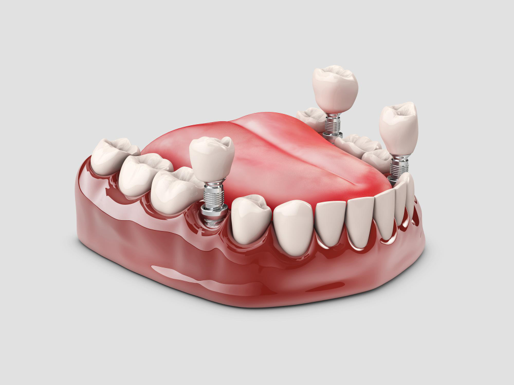 Dental implant uygulaması