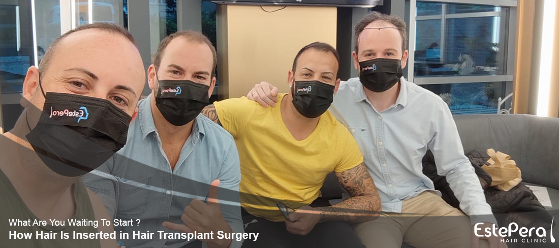 How Hair Is Inserted in Hair Transplant Surgery