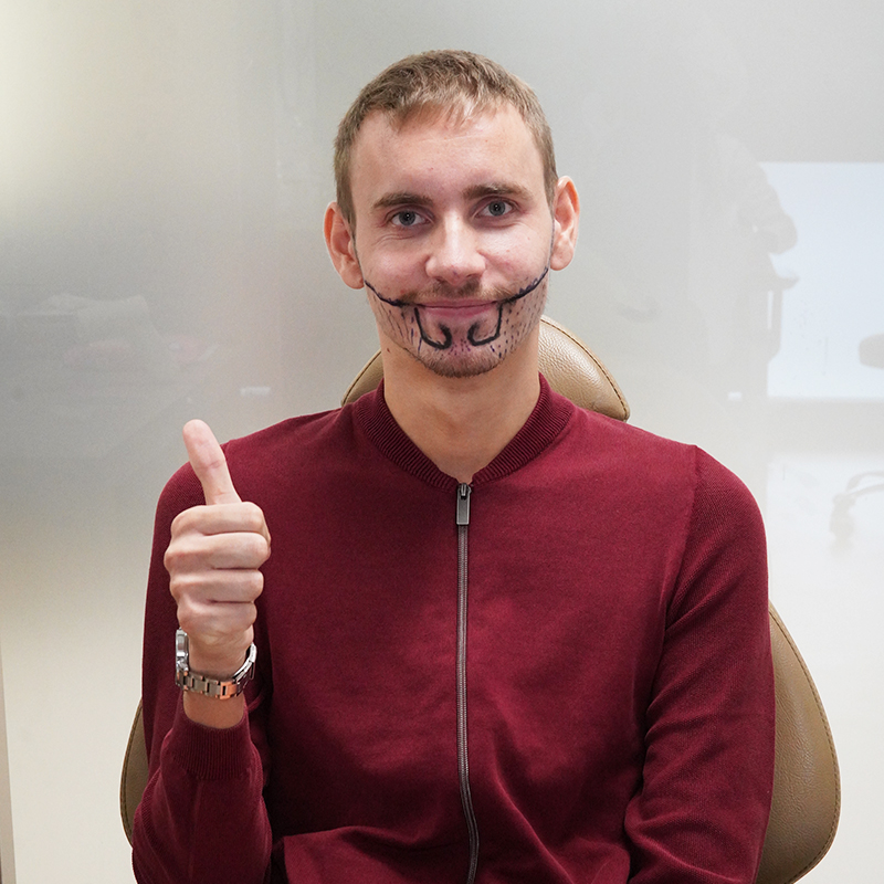 Moustache Transplant in Turkey