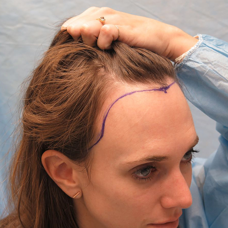 Female Hair Transplant