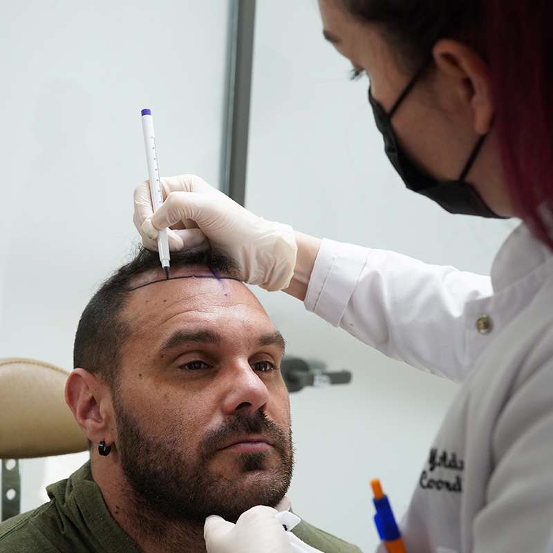 How to Hide Fue Hair Transplant? Conceal A Hair Transplant