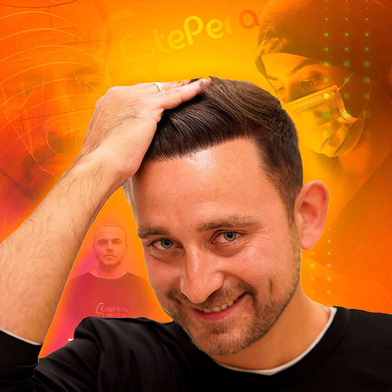 Unshaven FUE Hair Transplant