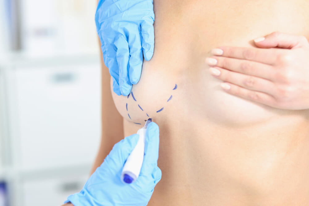 Breast Augmentation