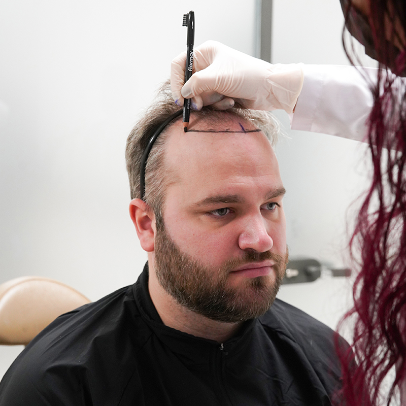 What Is Fue Hair Transplant?