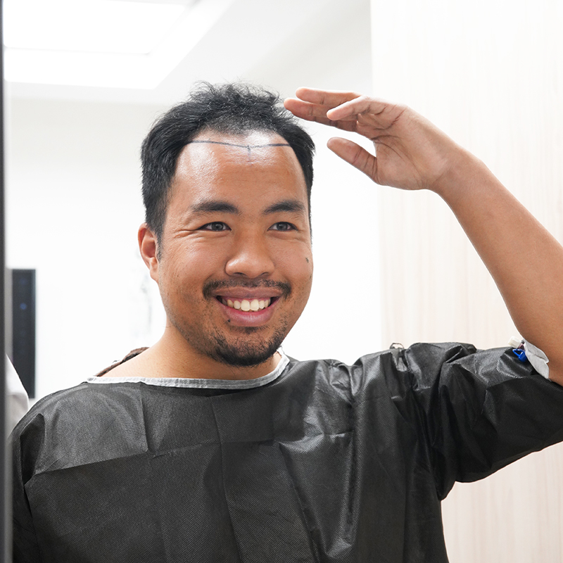 What is Bio Fue Hair Transplant?