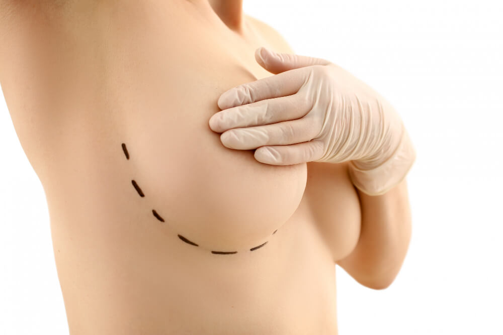 breast reduction