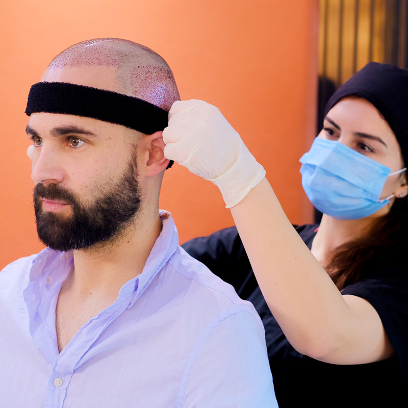 Fue Hair Transplant: How It is Done and How Long It Takes?