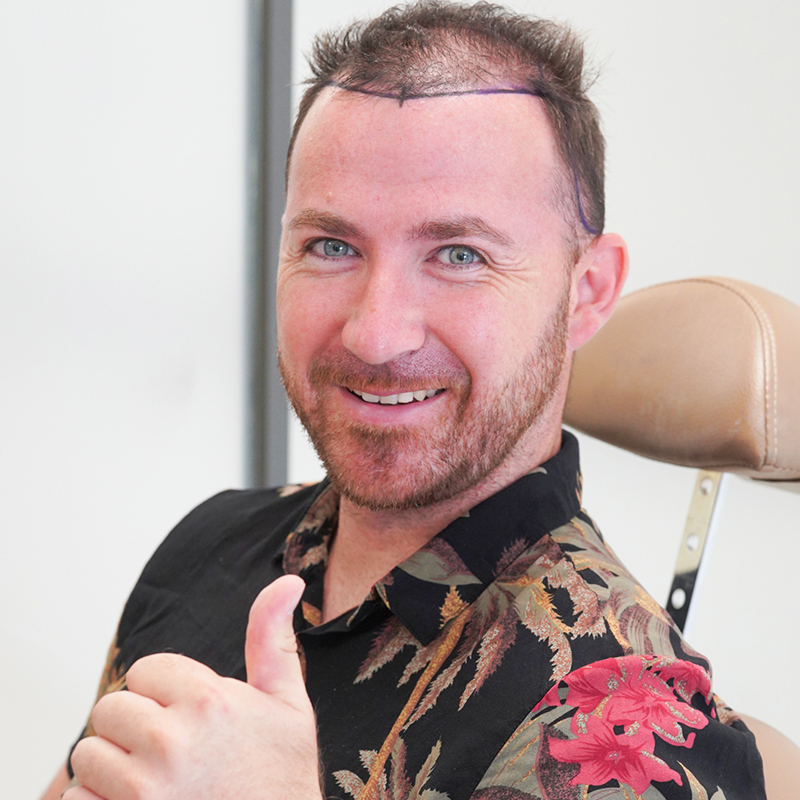 Hair Transplant in Turkey Cost 2025