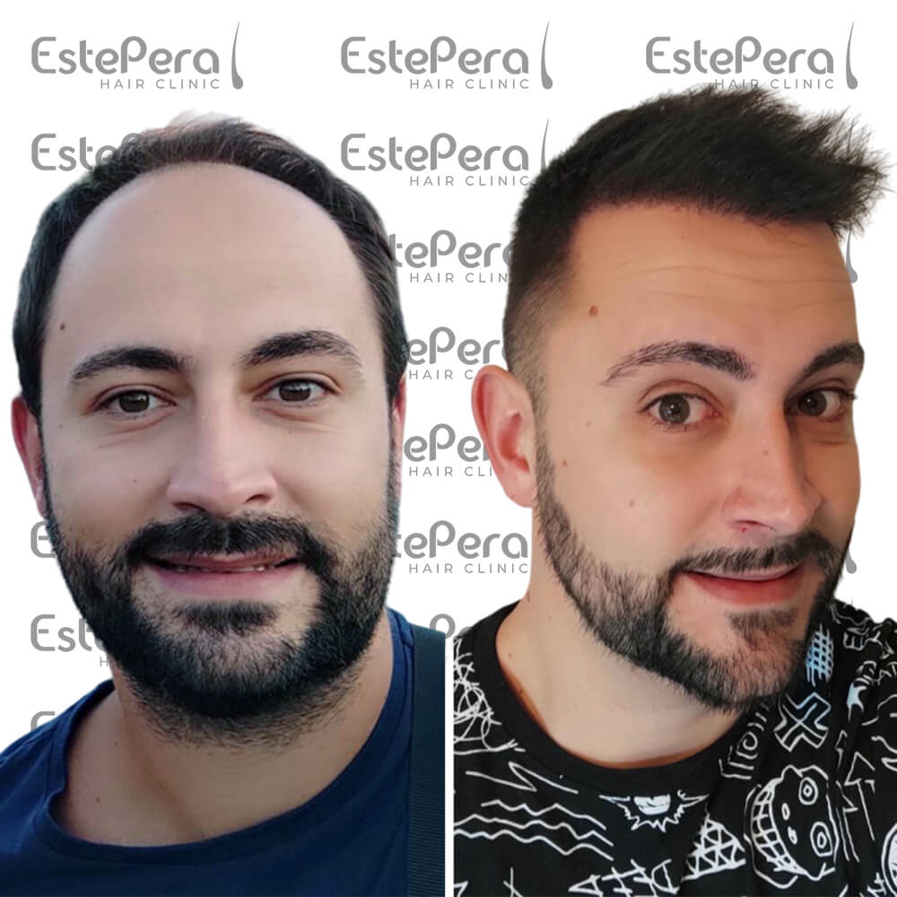 Unshaven Hair Transplant Estepera Hair Clinic Best Hair Transplant