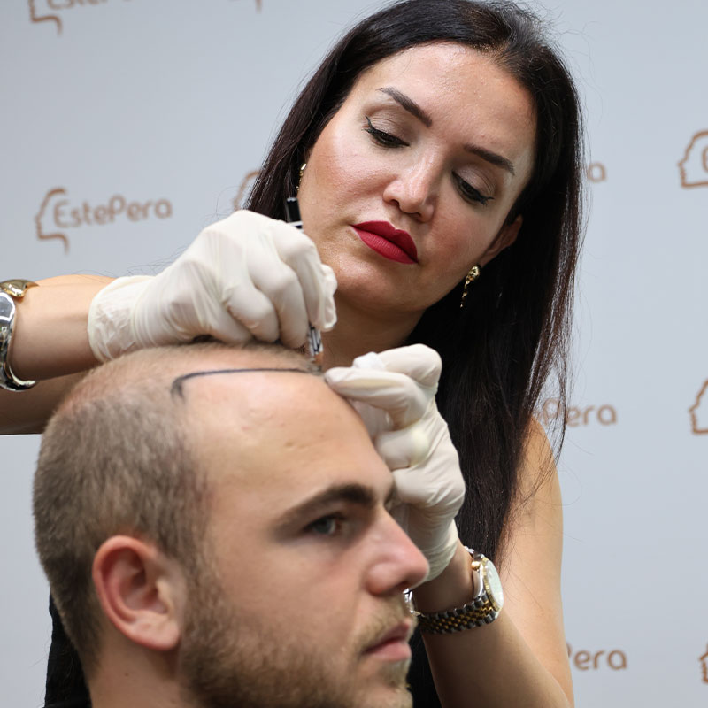 Understanding Alopecia Areata: An In-Depth Guide