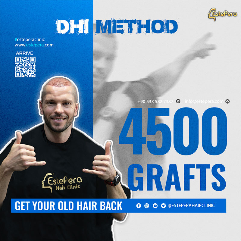 Hair Transplants For Curly