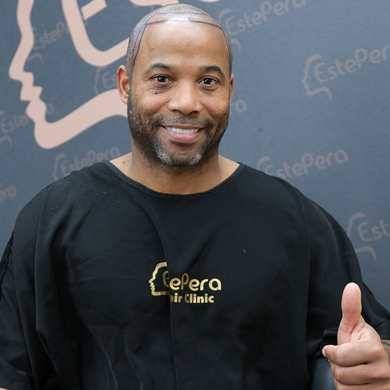 Receding Hairline in Black Men